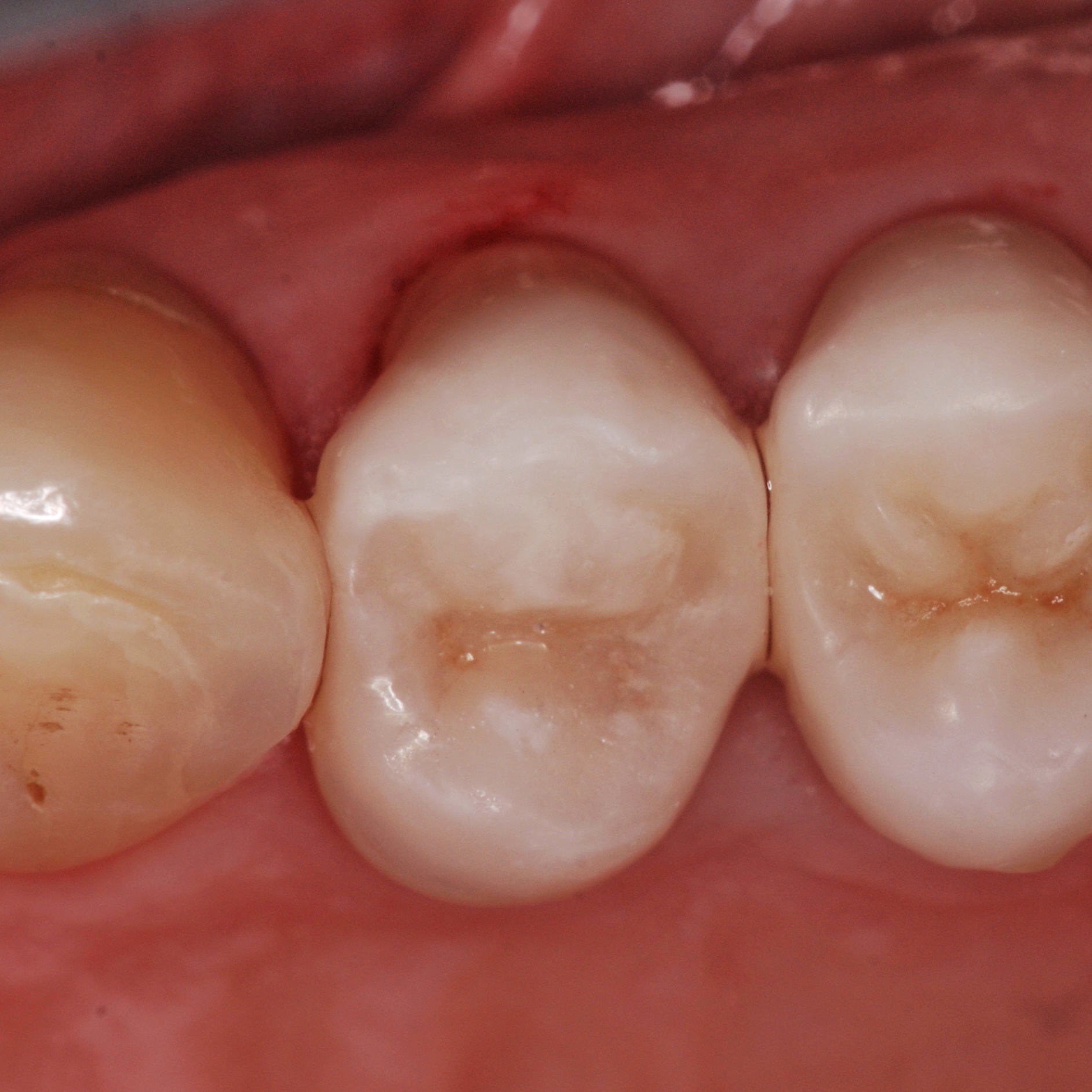 dentista-riccione-marcobartolini it intarsio-onlay-su-premolare-superiore 003