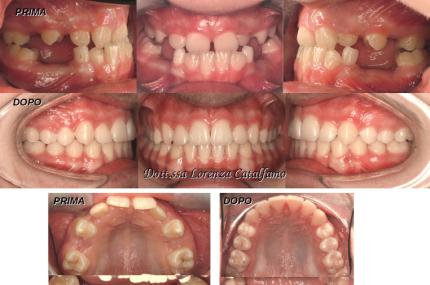 dentista-riccione-marcobartolini it casi-clinici 003