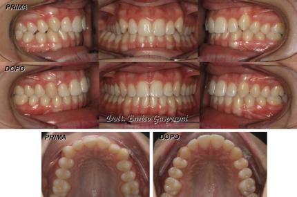 dentista-riccione-marcobartolini it casi-clinici 002