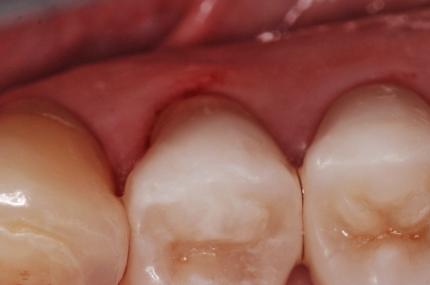 dentista-riccione-marcobartolini it casi-clinici 001